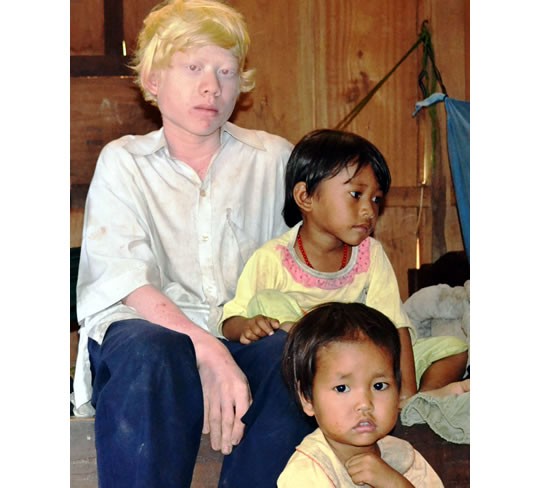 Ngoài ngoại hình da trắng, tóc bạc, mắt mờ, em Thái (bên trái) vẫn khỏe mạnh như bao đứa trẻ khác. Ảnh: KHÁNH NGUYỄN